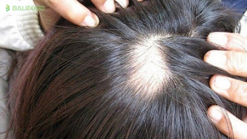 Rụng tóc từng mảng có mọc lại được không? Nguyên nhân và cách điều trị