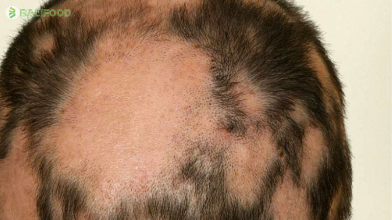 Rụng tóc từng mảng có mọc lại được không? Nguyên nhân và cách điều trị